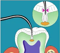 Diagnodent Laser Cavity Detection