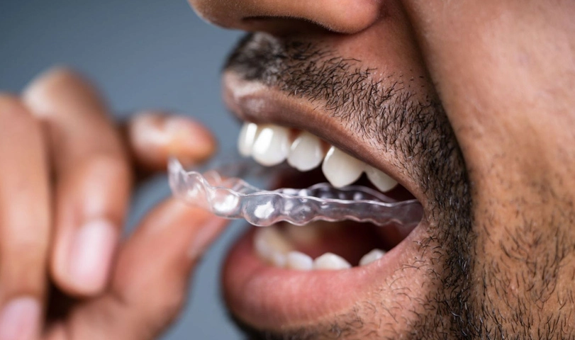 Invisalign