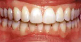 Braces - Orthodontics